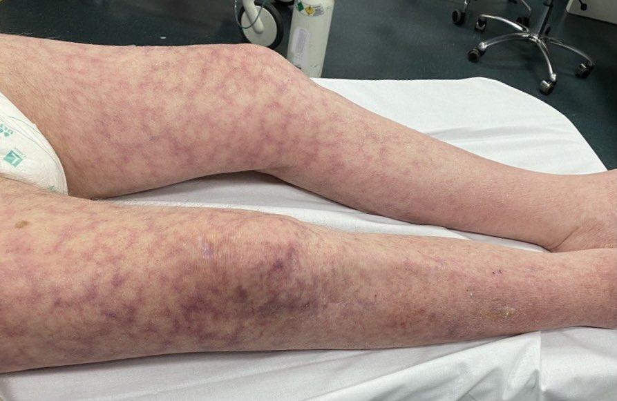 Skin Mottling in Septic Shock (from urosepsis) - ... | GrepMed